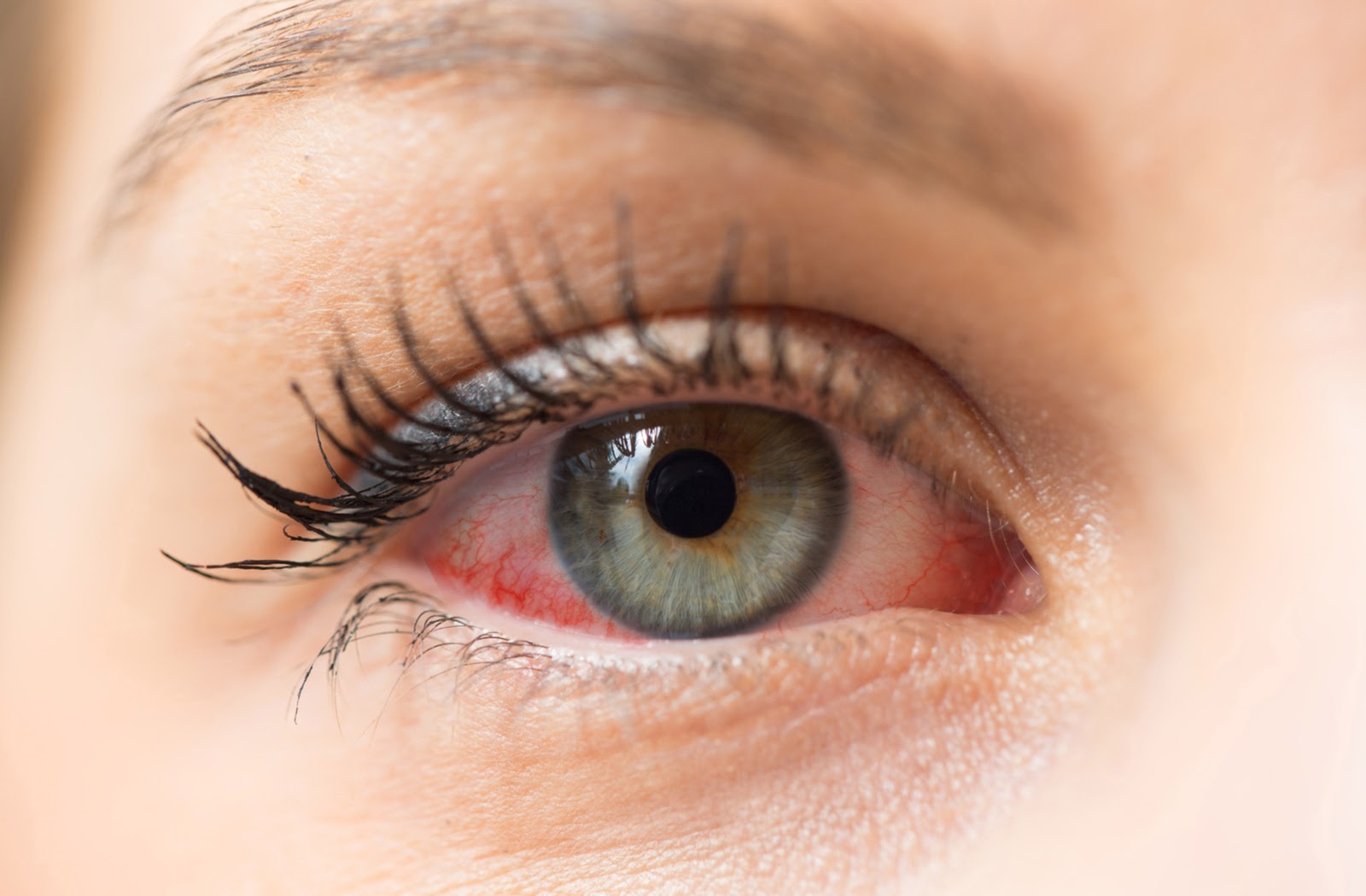 Red Eyes: Causes and Treatment for Bloodshot Eyes