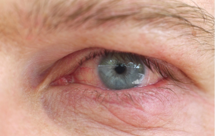 A close-up of a person's eye that is suffering from dry eye