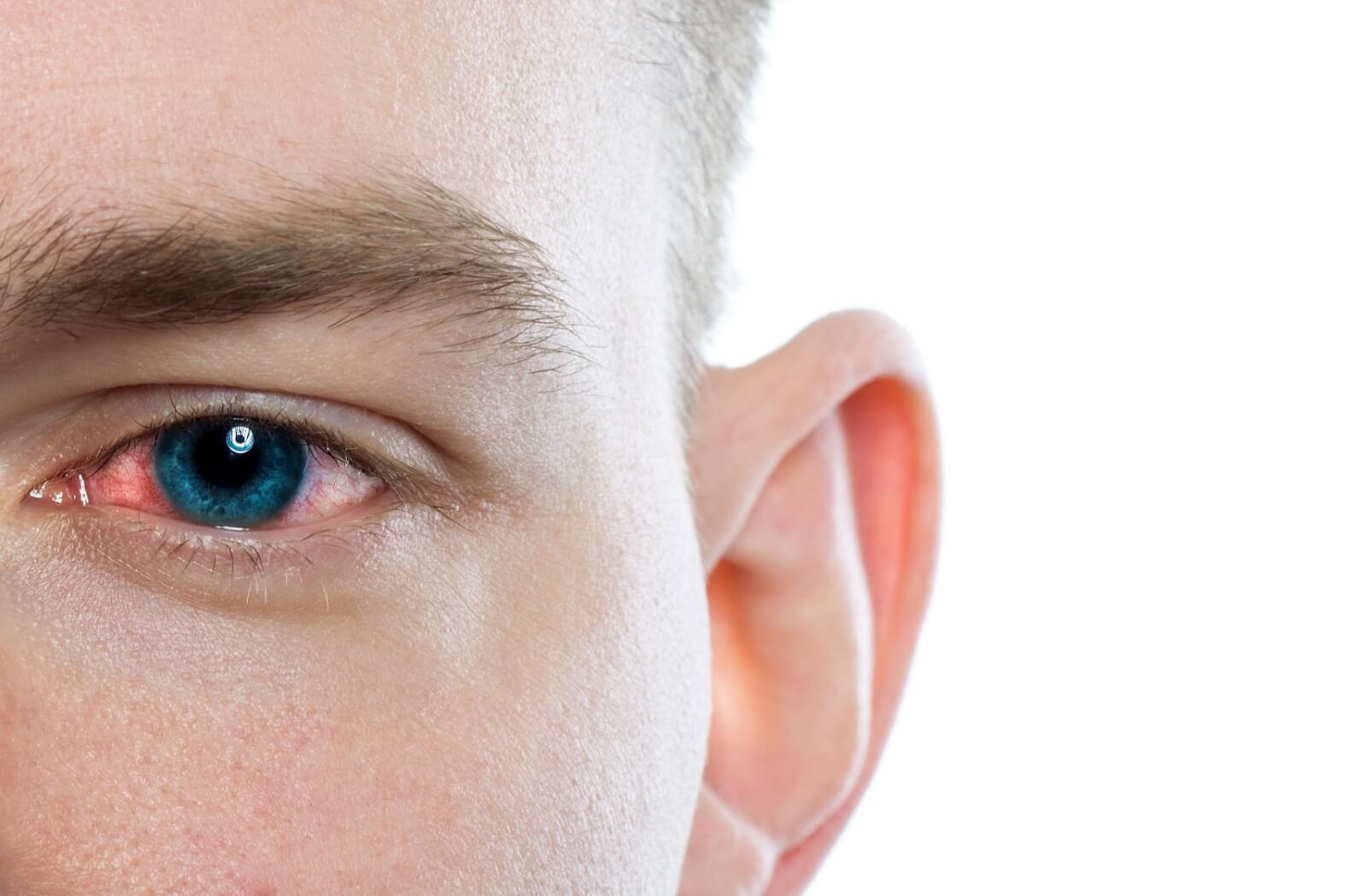 Close-up of an irritated eye showing signs of pink eye.